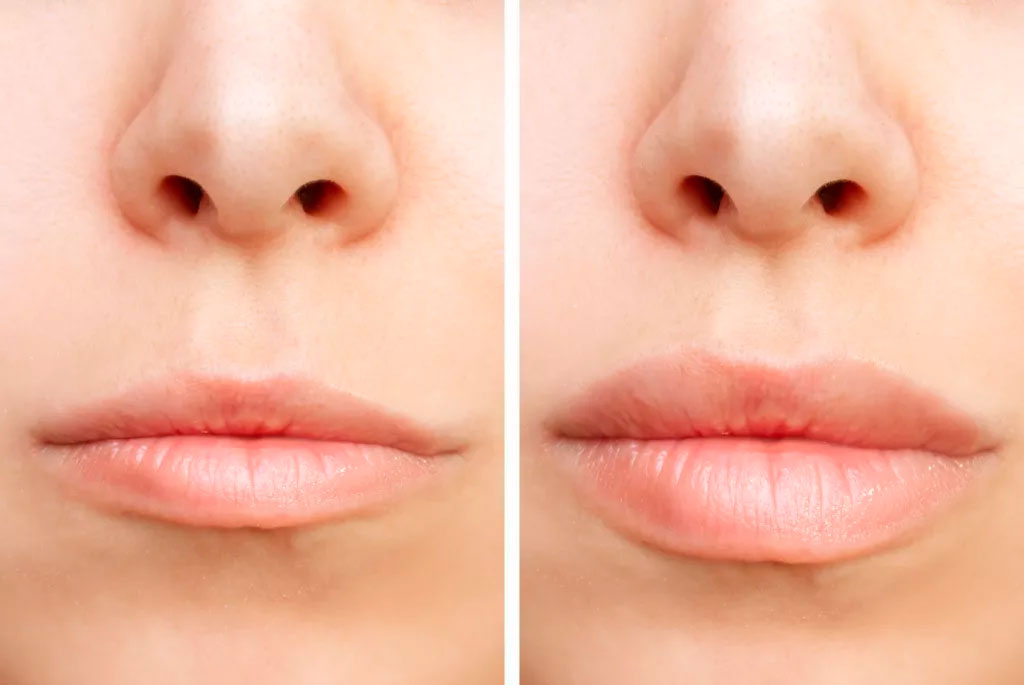 Antes e depois de um procedimento de preenchimento labial. Rosto de uma mulher, exibindo seus lábios antes e após realizar preenchimento.