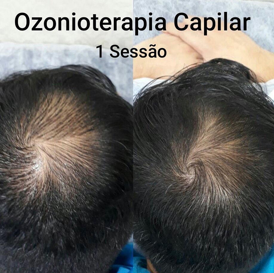 Antes e depois do tratamento de ozonioterapia capilar, mostrando que após apenas uma seção o paciente já  teve melhoras.